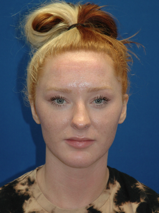 Rhinoplasty — before (frontal)
