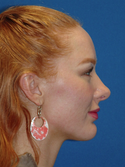 Rhinoplasty — after (profile)