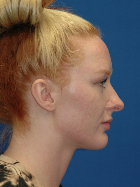 Rhinoplasty — before (profile)