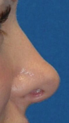 Rhinoplasty — after (nose close-up)