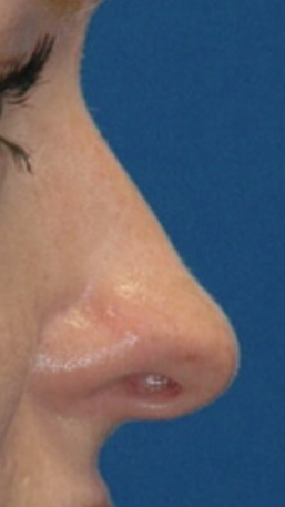 Rhinoplasty — before (nose close-up)